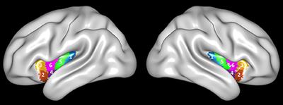 Functional Connectivity of Anterior Insula Predicts Recovery of Patients With Disorders of Consciousness